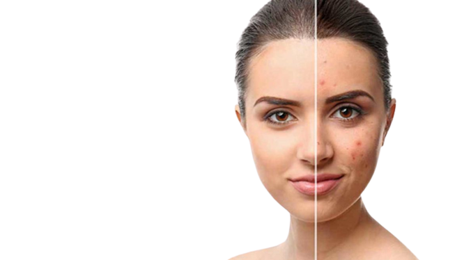 Acne Scar Treatment in Ahmedabad