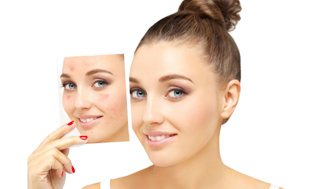 Acne Scar Treatment in Ahmedabad